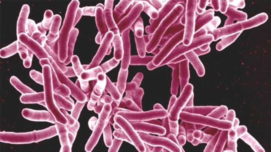 NIH Launches Large TB Prevention Trial for People Exposed to Multidrug-Resistant TB